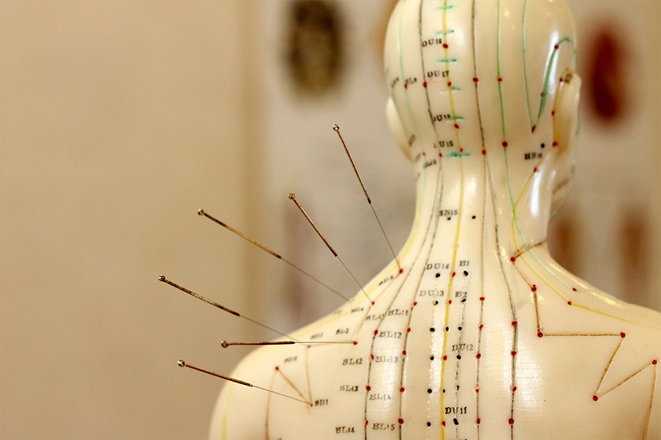 acupuncture traditionnelle